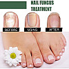 EELHOE Nail Fungus - Революционен Лак за Здрави Нокти | Здраве