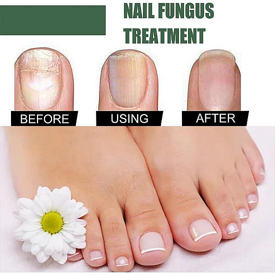 EELHOE Nail Fungus - Революционен Лак за Здрави Нокти | Здраве